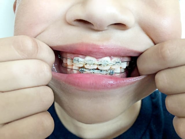 niềng răng cho trẻ